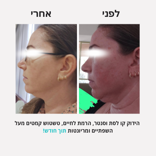 לירון - לפני אחרי פורמט חדש - 13