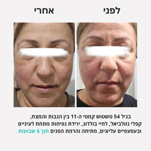 לירון - לפני אחרי פורמט חדש - 4 (1)