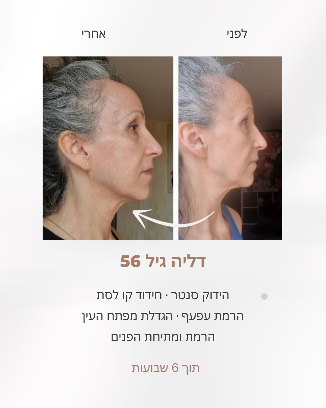 דליה בת 56, לפני ואחרי 6 שבועות: הידוק סנטר, חידוד קו לסת והרמת עפעף