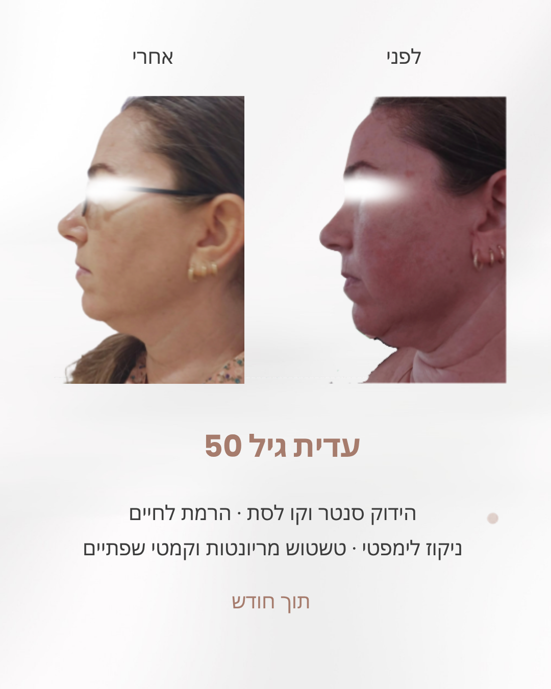 עדית בת 50, לפני ואחרי חודש: הידוק סנטר כפול וקו לסת, הרמת לחיים וטשטוש קמטי מריונטות