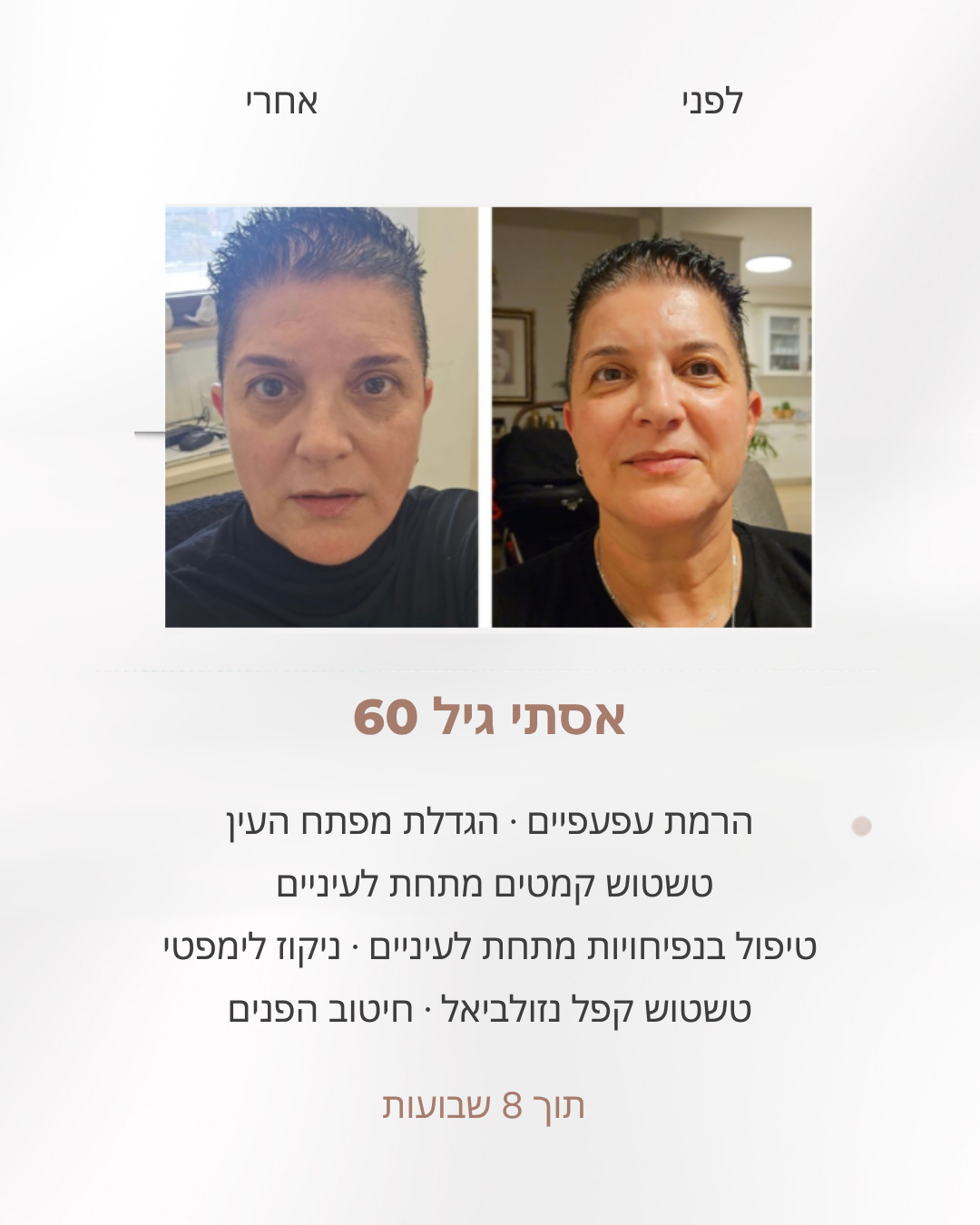 אסתי בת 60, לפני ואחרי 8 שבועות: הרמת עפעפיים בצורה טבעית, מפתח עין גדול יותר ופחות נפיחות מתחת לעיניים
