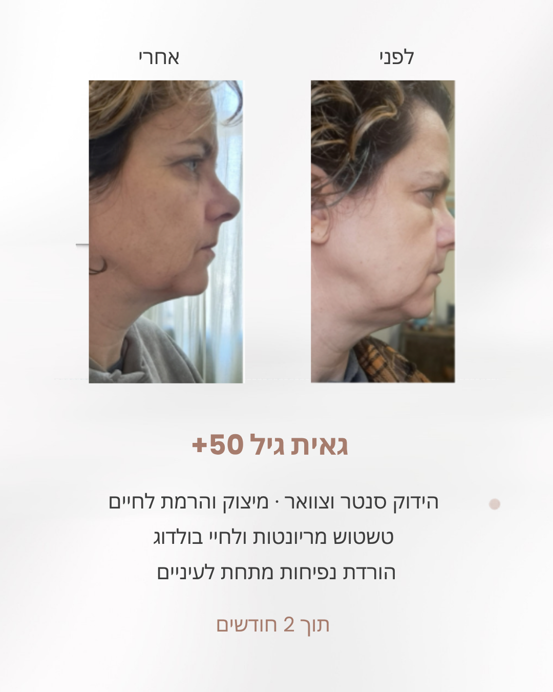 גאית בת 50, לפני ואחרי חודשיים: ירידת נפיחות מתחת לעיניים, הידוק סנטר וצוואר והרמת לחיים
