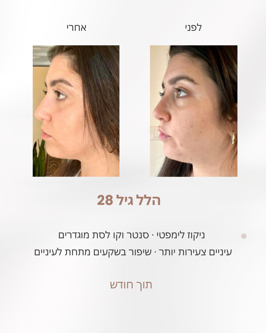 הלל בת 28, לפני ואחרי חודש בשיטת לירון שוורץ: פחות נפיחות בפנים, סנטר וקו לסת מוגדרים יותר