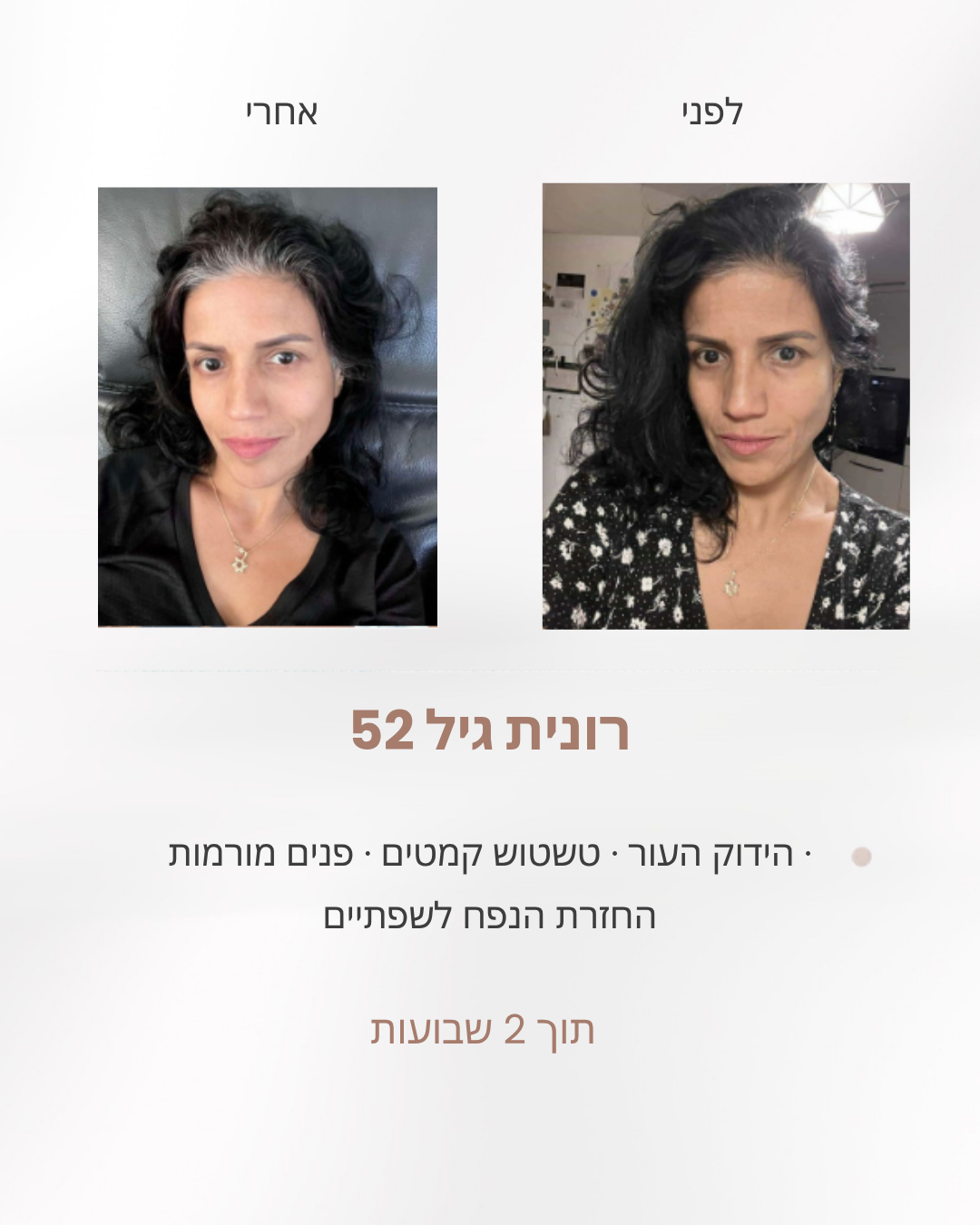 רונית בת 52, לפני ואחרי שבועיים של תרגילי פנים: הידוק העור, טשטוש קמטים ופנים מורמות