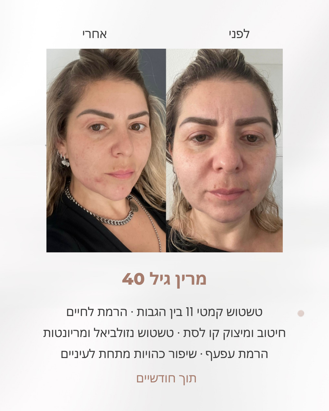 לפני ואחרי הרמת לחיים ואיזון הפנים אצל אישה בת 40, לפי שיטת לירון