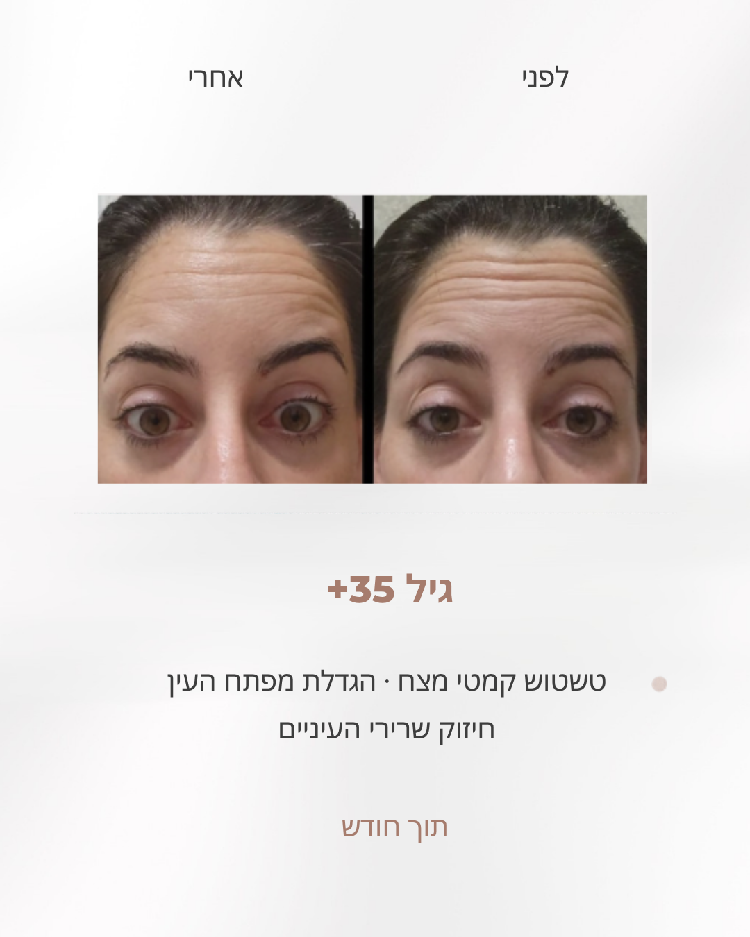 לפני ואחרי שיפור ופתיחת מבט באזור העיניים והגבות אצל אישה בת 35 פלוס, לפי שיטת לירון