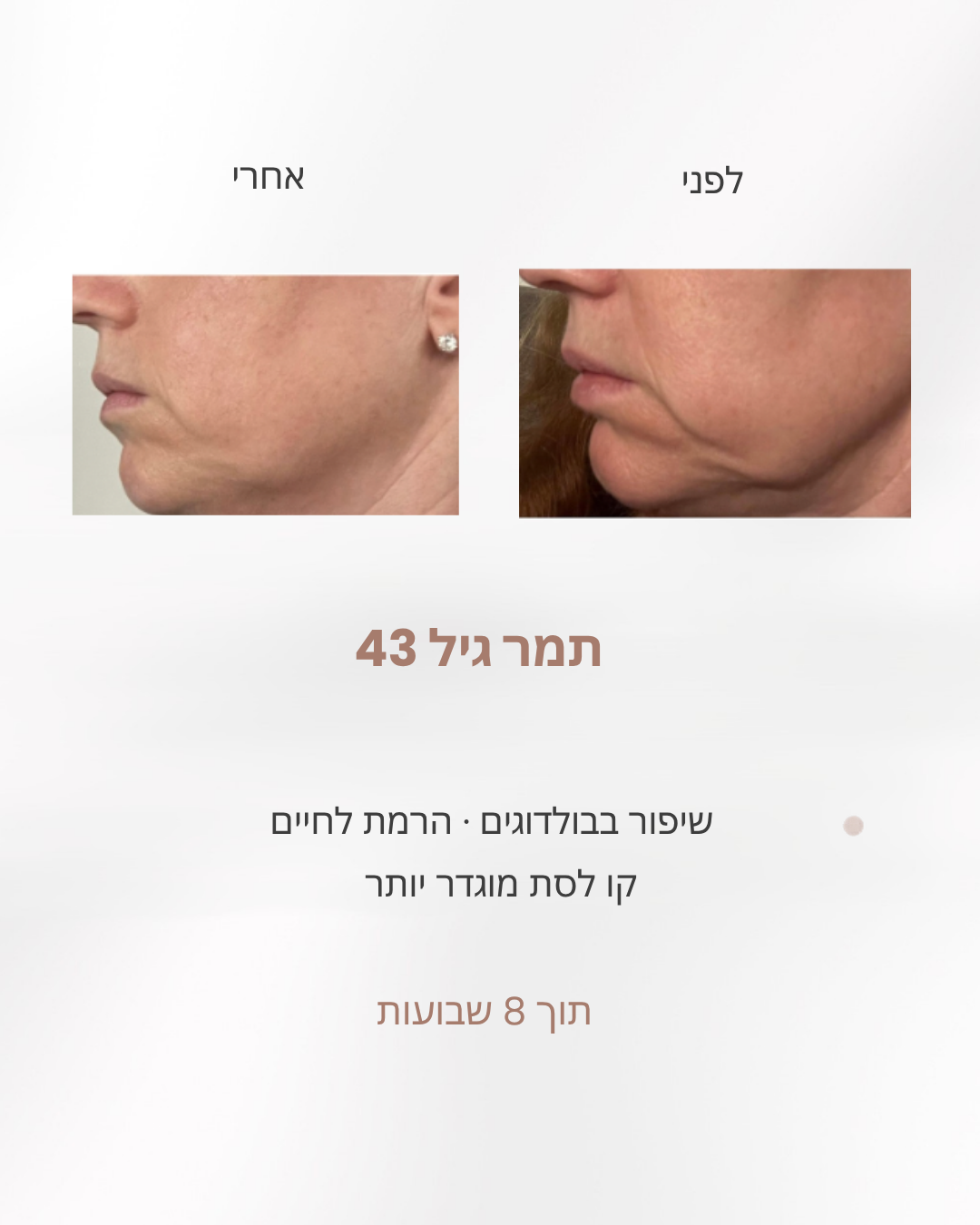 תמר בת 43, לפני ואחרי 8 שבועות: חיטוב קו לסת מוגדר יותר, שיפור בלחיי בולדוג והרמת לחיים