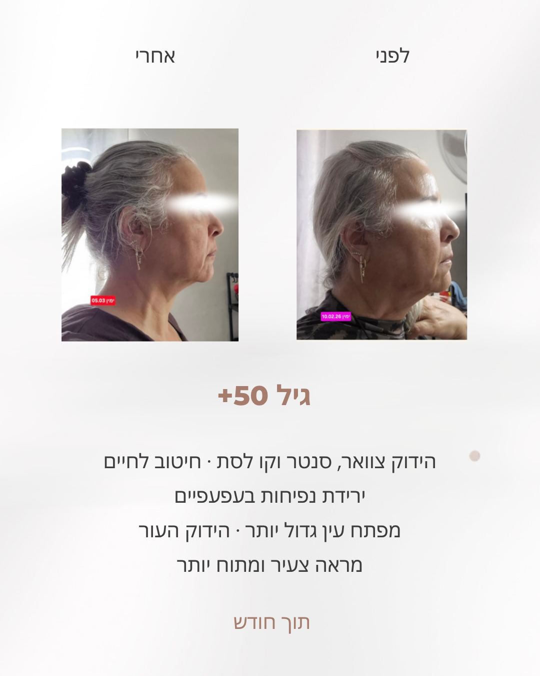 אישה בת 50 פלוס, לפני ואחרי חודש: הידוק סנטר כפול וצוואר, חיטוב לחיים וירידת נפיחות בעפעפיים