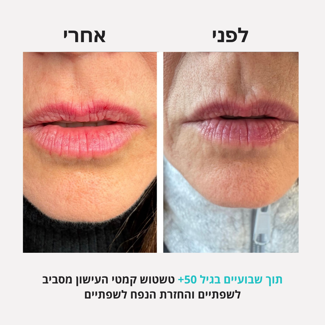 אישה בת 50 פלוס, לפני ואחרי שבועיים: טשטוש קמטי שפתיים והחזרת נפח לשפתיים