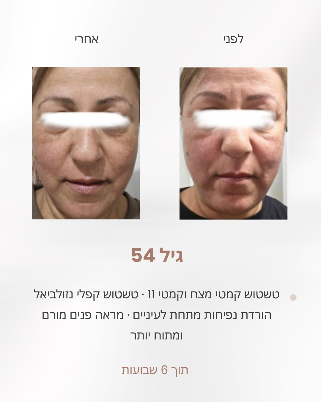 אישה בת 54, לפני ואחרי 6 שבועות של תרגילי פנים: קמטי מצח וקמטי 11 מרוככים ופחות נפיחות מתחת לעיניים