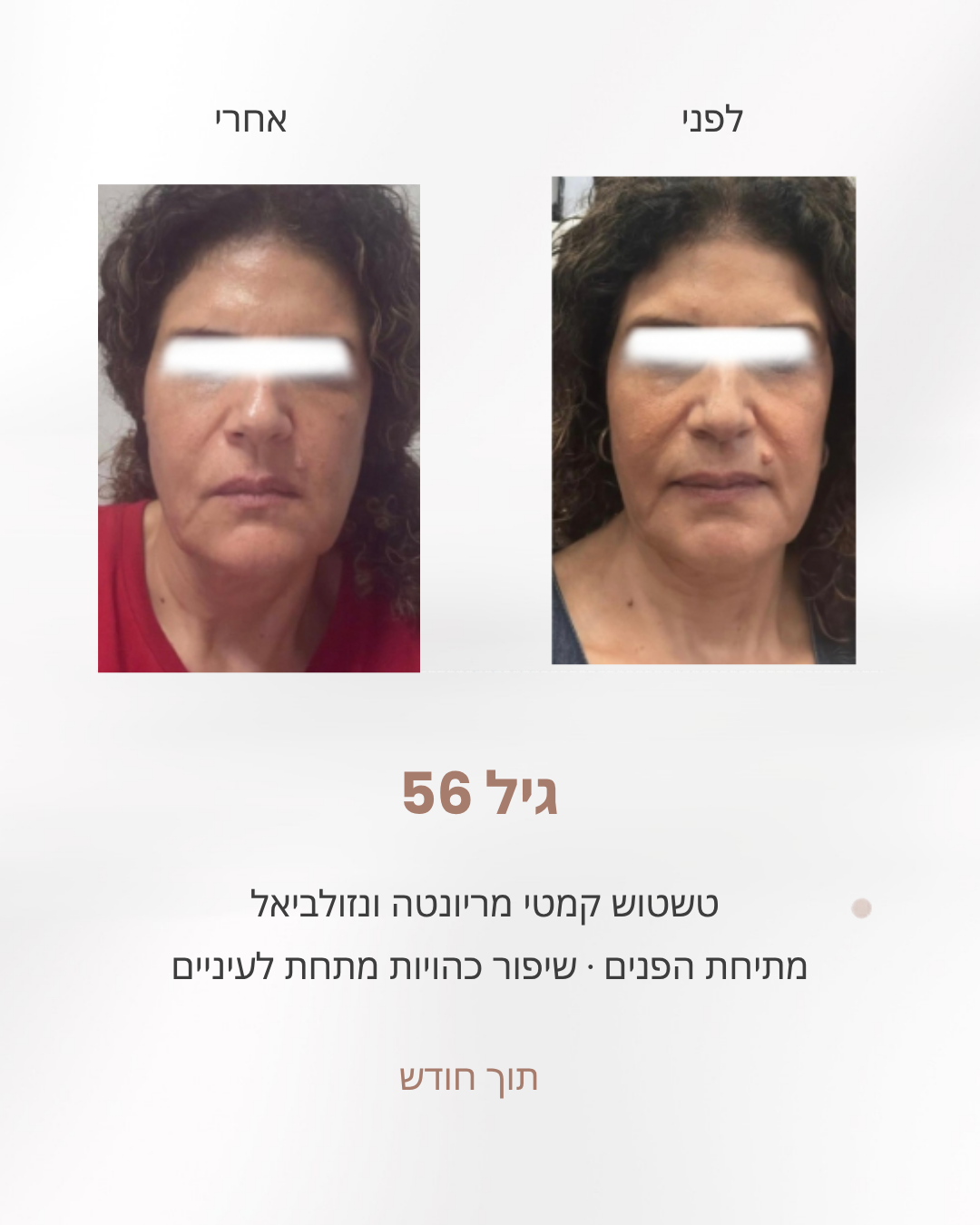 אישה בת 56, לפני ואחרי חודש של תרגילי פנים: טשטוש קמטי מריונטה, מתיחת פנים ושיפור בכהויות מתחת לעיניים