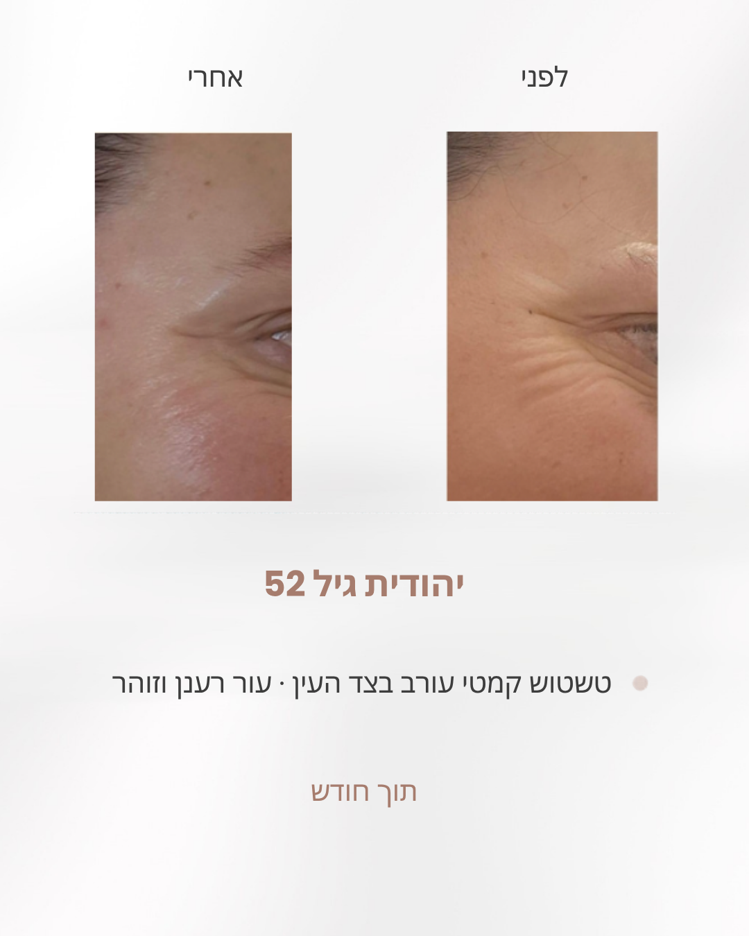 לפני ואחרי ריכוך קמטי עורב בצד העין, יהודית בת 52, אחרי חודש עבודה לפי שיטת לירון