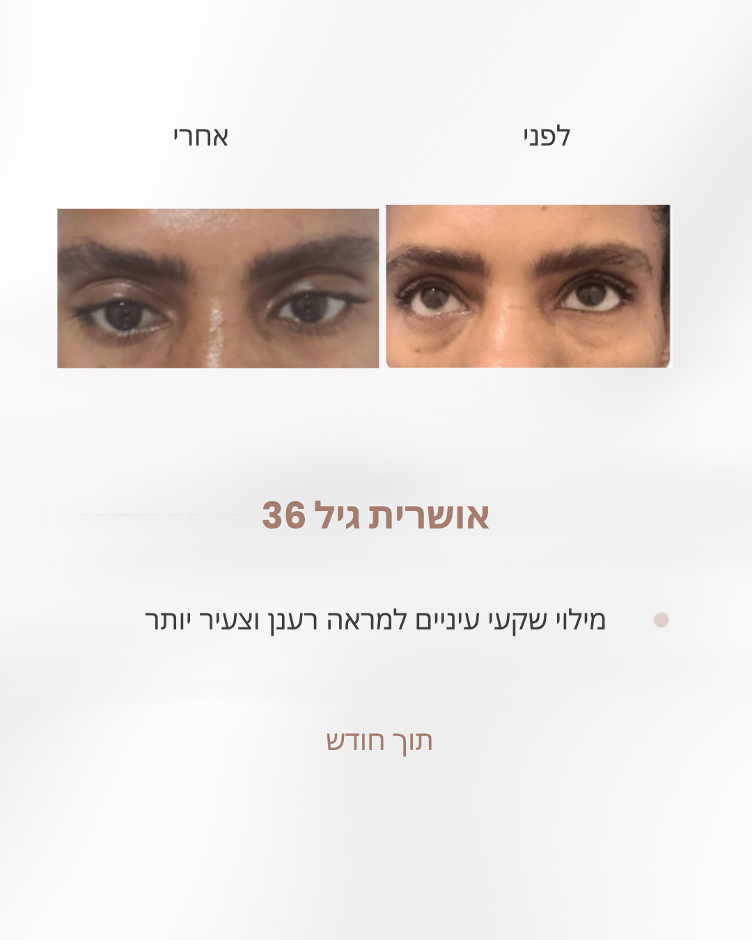 לפני ואחרי מילוי שקעי העיניים למראה רענן יותר, אושרית בת 36, אחרי חודש עבודה לפי שיטת לירון