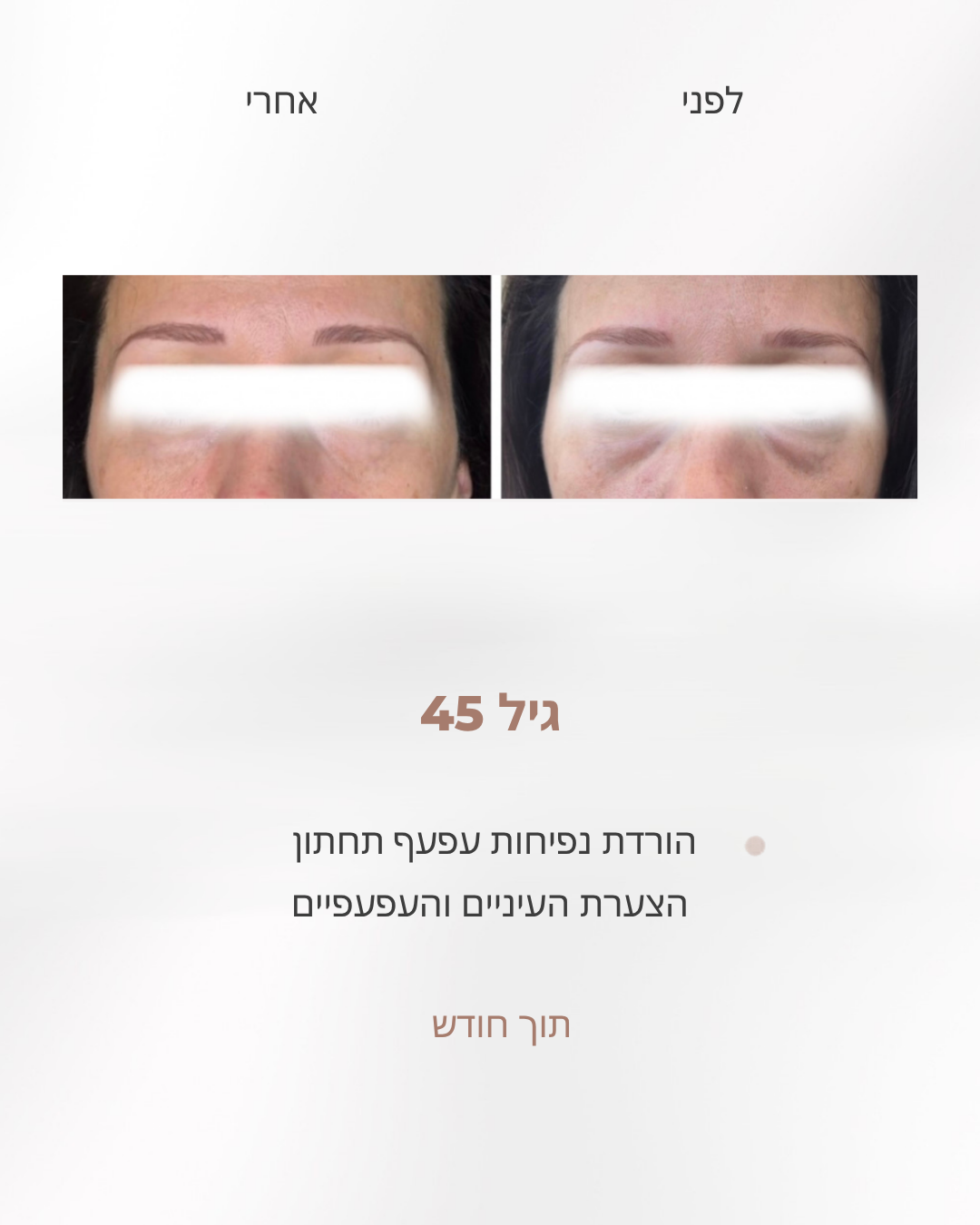 לפני ואחרי הורדת נפיחות בעפעף התחתון והצערת אזור העיניים, אישה בת 45, אחרי חודש עבודה לפי שיטת לירון