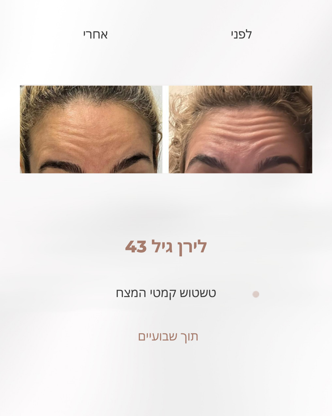 לפני ואחרי טשטוש קמטי המצח, לירן בת 43, אחרי שבועיים של עבודה לפי שיטת לירון